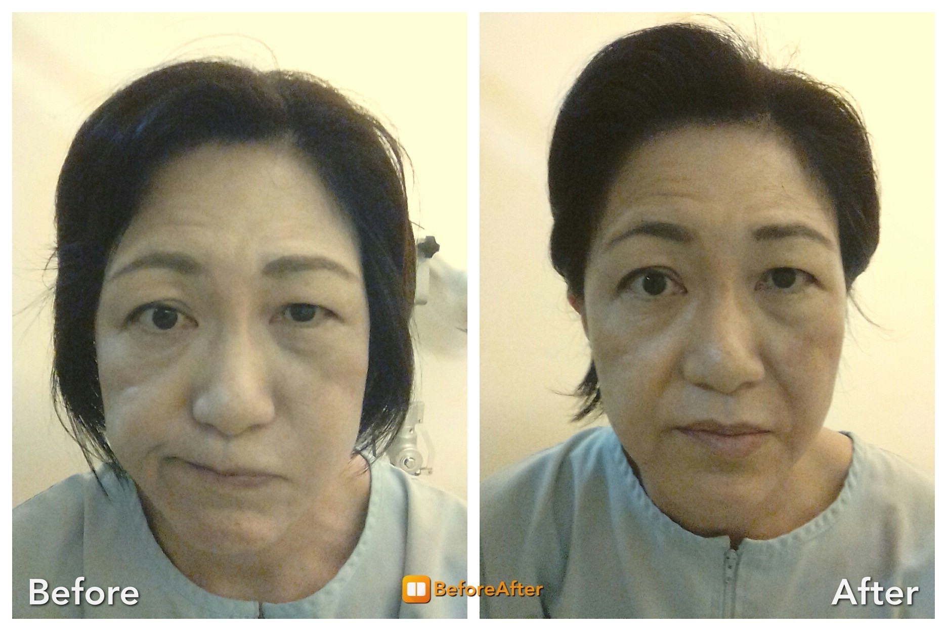 顔面神経麻痺 鍼灸治療レポート6 Hari Up ハリアップ Dr Liu Method